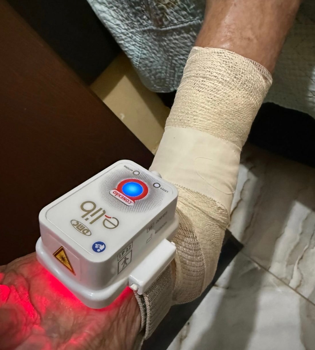 Aplicação de laserterapia em um membro enfaixado durante o atendimento